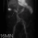 Purple arrows: Development of abnormal radiotracer accumulation in the right upper quadrant.