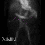 Purple arrows: Movement of the radiotracer across the upper abdomen along the expected course of the transverse colon.