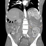 Left lower quadrant renal transplant responsible for the abnormal radiotracer distribution shown on anatomic imaging (yellow arrows).