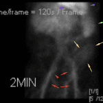 Early radiotracer accumulation in the left lower quadrant (yellow arrows). Blood pool (red arrows - iliac arteries, purple arrows - heart). Splenic uptake (green arrows).