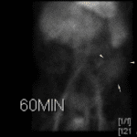 No change in shape or position of the area of radiotracer uptake in the left lower quadrant at 60 minutes (yellow arrows).