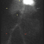 Normal background activity without abnormal areas of uptake on early imaging. Expected uptake in the liver (yellow arrows), spleen (green arrow), and iliac vessels (red arrows).