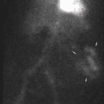 New abnormal area of radiotracer uptake in the left lower quadrant (pink arrows).
