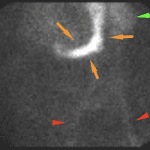 Activity conforming to the shape of the stomach, which when compared to the flow imaging, corresponds to the early site of abnormal activity in the mid central abdomen (orange arrows). Vascular uptake (red arrows). Splenic uptake (green arrow).