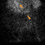 Accumulation of radiotracer in the upper central abdomen early in the study (orange arrows).
