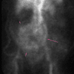 Delayed imaging showing persistence of the abnormal area of radiotracer activity (pink arrows).