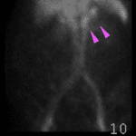 Abnormal radiotracer accumulation in the region of the stomach at 10 minutes (pink arrows).
