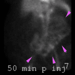 Progressive movement of the abnormal radiotracer activity throughout the left hemiabdomen in a tubular configuration consistent with downstream transit in the proximal small bowel (pink arrows).