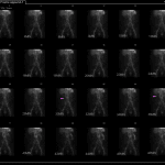Appearance of an abnormal area of radiotracer activity which moves over time conforming to bowel loops (pink arrows). These findings are best demonstrated on the cine clips.