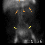 Early imaging shows faint uptake in the left upper quadrant corresponding with the stomach (orange arrows). Rounded area of activity in the pelvis corresponds with the urinary bladder (yellow arrows).