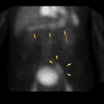 Delayed imaging: Persistent activity in the stomach (orange arrows). Increasing activity in the region of the bladder with slight asymmetry on the left (yellow arrows).