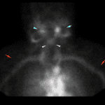 View of the neck shows evidence of free pertechnetate including salivary gland uptake (blue arrows) and thyroid uptake (pink arrows). Expected blood pool activity (red arrows).