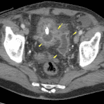 CT from the same patient demonstrating left bladder diverticula (yellow arrows) which explains the asymmetric activity in the left hemipelvis.
