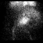 Angiographic phase: Early appearance of a large abnormal oval area of radiotracer activity in the central abdomen just above the level of the aortic bifurcation (red arrows). Blood pool activity in the heart (pink arrows). Injection site (blue arrow).