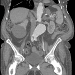 Corresponding CT from the same patient showing extensive atherosclerotic disease with an infrarenal abdominal aortic aneurysm (red arrows).