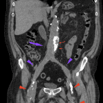 CT from same patient demonstrates aortobifemoral bypass postsurgical anatomy with densely calcified native vasculature (red arrows) and bypass graft (purple arrows).