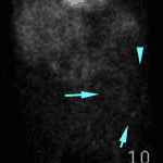 Angiographic phase shows early appearance of the abnormal areas of radiotracer activity in the left hemiabdomen (turquoise arrows).