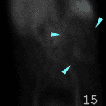 Delayed imaging shows no change in size or location of these areas of abnormal activity (turquoise arrows).
