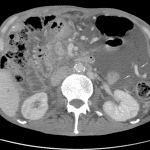CT in the same patient demonstrates multiple varices in the left hemiabdomen (turquoise arrows).