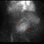 Delayed imaging shows similar size and morphology of the abnormal area of radiotracer activity in the abdomen (red arrows).