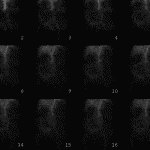 Angiographic phase showing early appearance of a large abnormal area of radiotracer activity (pink arrows).