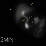 Normal early imaging with normal hepatic uptake (yellow arrows), normal excretion into the common bile duct (green arrows), and normal excretion into bowel (brown arrows).