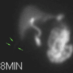 Faint linear activity along the right flank (green arrows) correlating with known surgical drains.