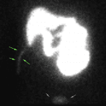 After windowing, the radiotracer accumulation within the surgical drains is more apparent (green arrows). Normal activity in the urinary bladder (orange arrows). Infiltration at site of injection in the left arm (purple arrows).