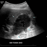 Initial postoperative ultrasound in this patient showing a heterogeneous collection in the gallbladder fossa (blue arrows).
