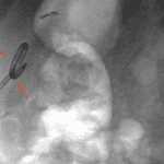 External biliary drain was then placed by interventional radiology (red arrows).
