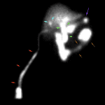 Activity in the gallbladder fossa (blue arrows) and surgical drain/reservoir (red arrows). Enterogastric reflux of bile (purple arrow). Normal activity in the bowel (brown arrows) and extrahepatic bile ducts (green arrows).