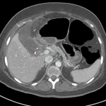 Postsurgical collection in the gallbladder fossa (blue arrows). Cholecystectomy clips (red arrows).
