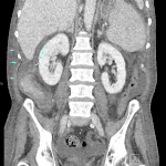 Presentation CT in this patient showing collections about the right lobe of the liver and along the right paracolic gutter (blue arrows).