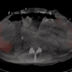 SPECT/CT correlate showing that the activity in the region of the right lobe of the liver corresponds to a perihepatic collection (blue arrows).