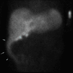 Early abnormal radiotracer accumulation in the right paracolic gutter (blue arrows).
