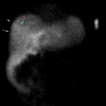 Apparent increasing activity seen over the right lobe of the liver later in the study (blue arrows).
