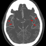 RCVS: red arrows show multiple areas of subtle narrowing of bilateral M2 and M3 branches of the MCAs on this representative axial MIP image.