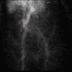 Small abnormal focus of radiotracer activity in the central abdomen (red arrows). Blood pool activity in the heart (purple arrows).
