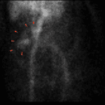 Movement of the radiotracer, seen best on the cine clips (red arrows).