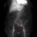 Red arrows show radiotracer in an anatomic distribution most consistent with the sigmoid colon. This is seen best on cine imaging.