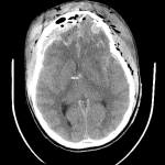 Head CT in the same patient at presentation showing extensive traumatic findings.