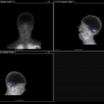 Static images show an area of activity in the cerebellum (blue circle).