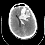 Head CT shows a large intraparenchymal hematoma and diffuse cerebral edema.