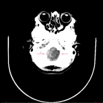 Head CT in the same patient shows crowding and hemorrhage about the brainstem in the foramen magnum (pink arrows).