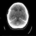 Head CT from the same patient demonstrates diffuse cerebral edema with diffuse sulcal effacement and effacement of the basal cisterns (blue arrows).