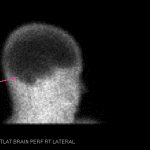 Static images show no intracranial activity in the cerebral cortex (blue arrows) or cerebellum (pink arrows).
