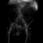 Anterior imaging: Focal area of radiotracer activity in the pelvis which did not change in morphology during the study (blue arrows). Expected blood pool uptake in iliac vessels (red arrows) and in the heart (pink arrows).