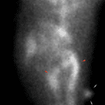 Single static lateral image: Pelvic activity seen on the anterior imaging localizes anteriorly, in the location of the male genitalia (blue arrows). Expected vascular uptake (red arrows).