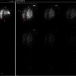RPO of the perfusion and ventilation images showing the left matched defects (green arrow), and the right mismatched defects (red and purple arrow), each of which involves greater than 75% of a pulmonary segment.