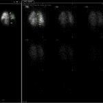 LPO of the V/Q imaging showing the multiple matched moderate defects in the posterior left lung. Remember, if abnormal on any phase of the ventilation imaging, it is considered abnormal and a match to the corresponding perfusion defect.
